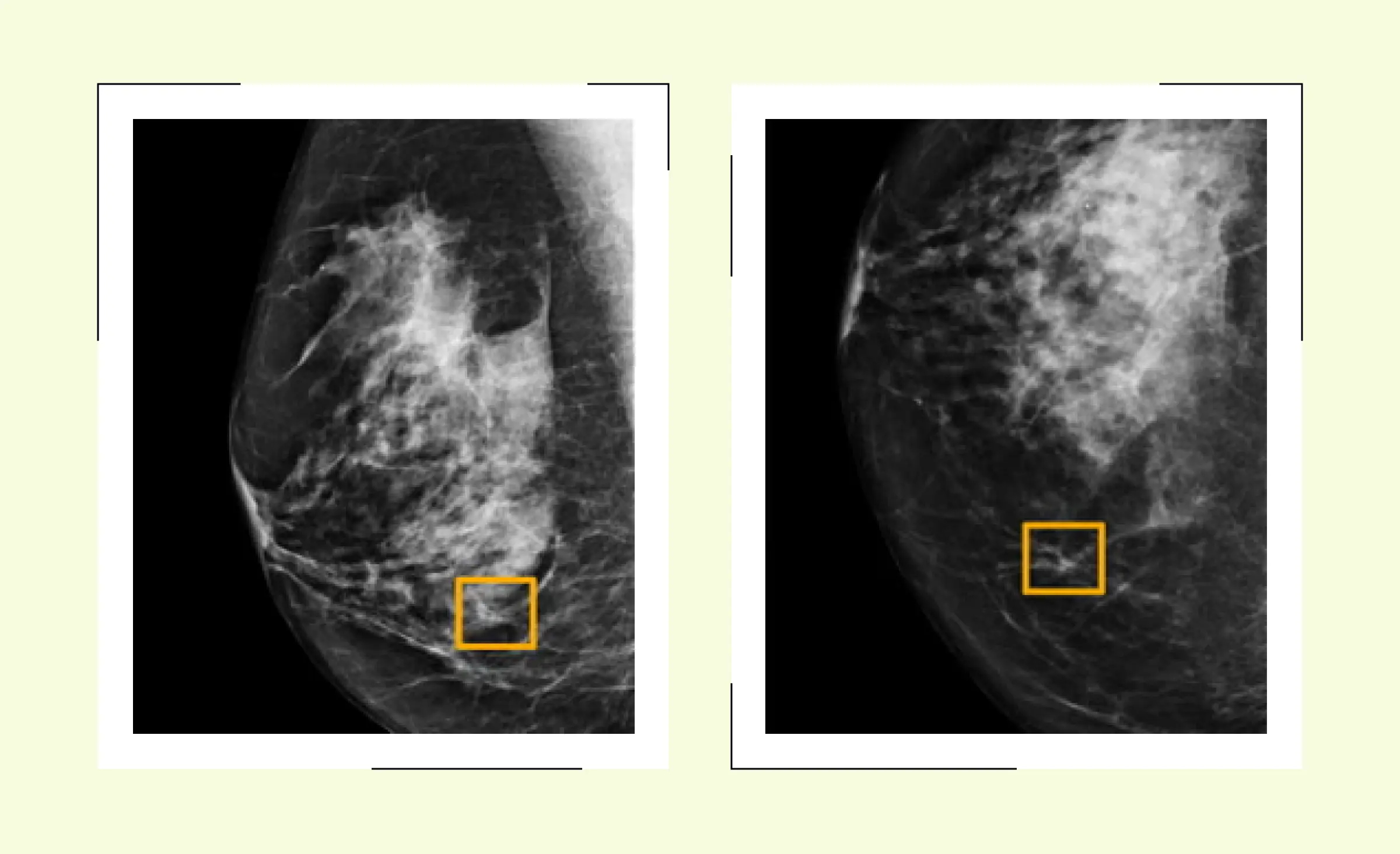 This image displays two mammogram scans with highlighted areas, illustrating how AI in healthcare patient diagnostics can assist in detecting abnormalities such as tumors more accurately and efficiently in medical imaging.